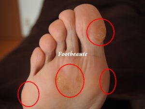 足裏にタコや魚の目が出来る理由 Footbeaute フットボーテ